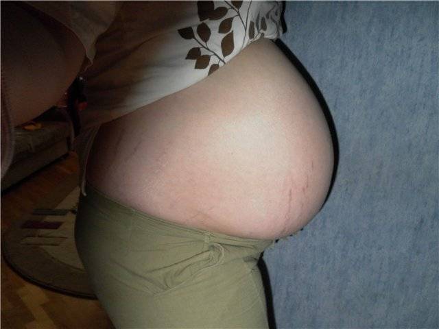Почему у беременных чешется живот