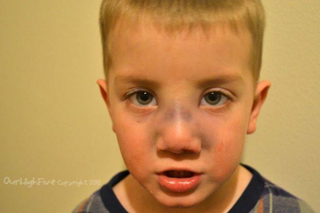 Признаки перелома носа у ребенка — как определить перелом