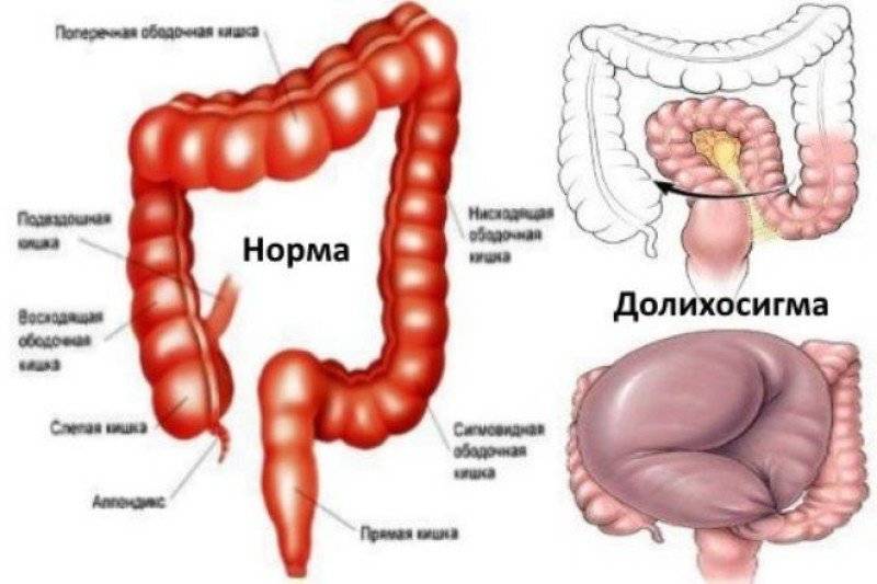 Долихосигма | симптомы | диагностика | лечение - docdoc.ru