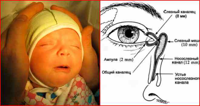 Массаж слезного канала у новорожденных