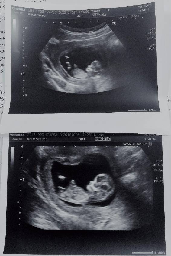 Как выглядит плод 11 12 недель беременности фото