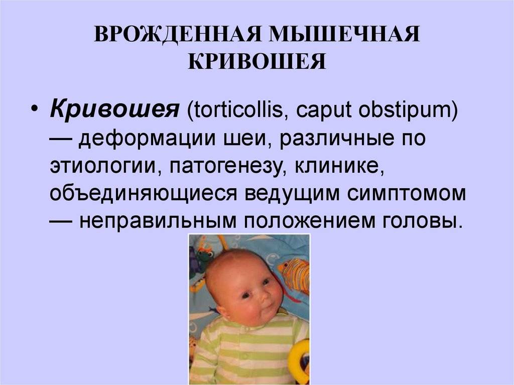 Кривошея - причины, признаки, методы лечения. кривошея у новорожденных :: polismed.com