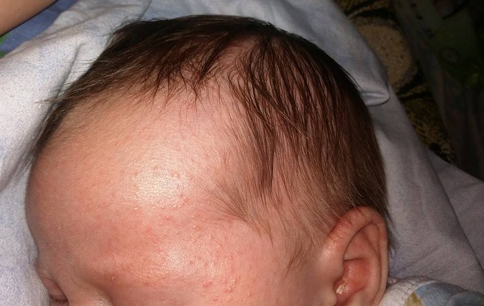 Щетина у новорожденных на спине: почему появляется и как ее убрать
