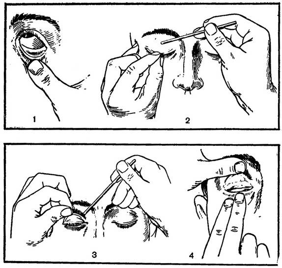 Что то попало в глаз. Алгоритм методики выворота верхнего века. Закладывание мази за веко алгоритм. Закладывание глазной мази стеклянной палочкой. Извлечение инородного тела из глаза.
