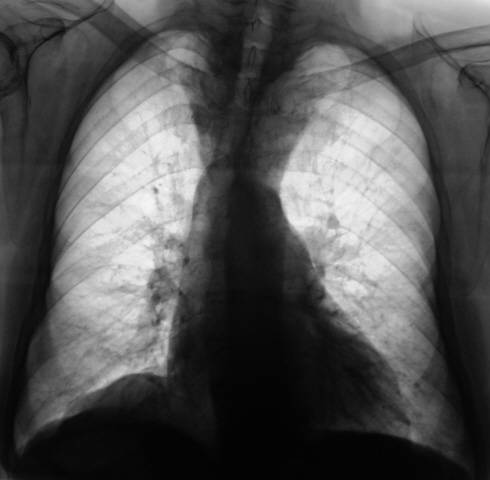 Рентген и флюорография при лактации: риски и последствия