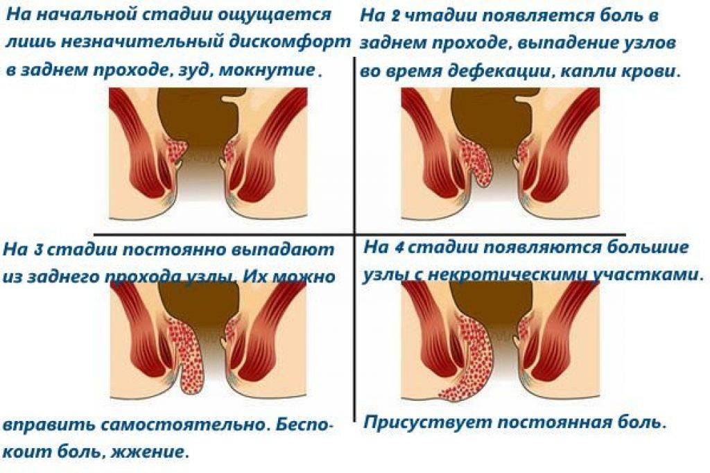 Геморрой после родов отзывы. Геморрой при беременности. Гемморойпри беременности.