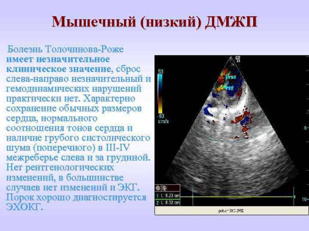 Дефект межжелудочковой перегородки. Инфундибулярный дефект межжелудочковой перегородки. Субтрикуспидальный дефект межжелудочковой перегородки. Перимембранозный дефект межжелудочковой перегородки. Подаортальный дефект межжелудочковой перегородки.