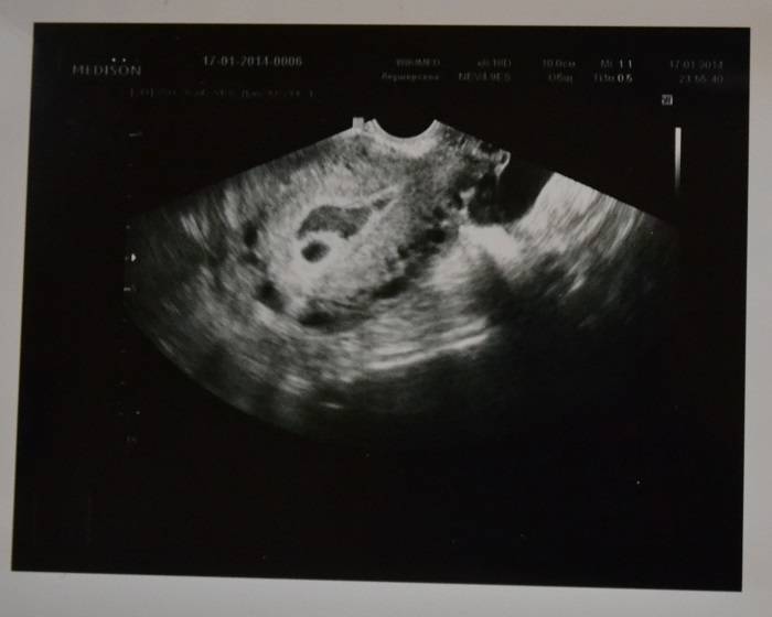 Развитие эмбриона и плода – восьмая неделя беременности