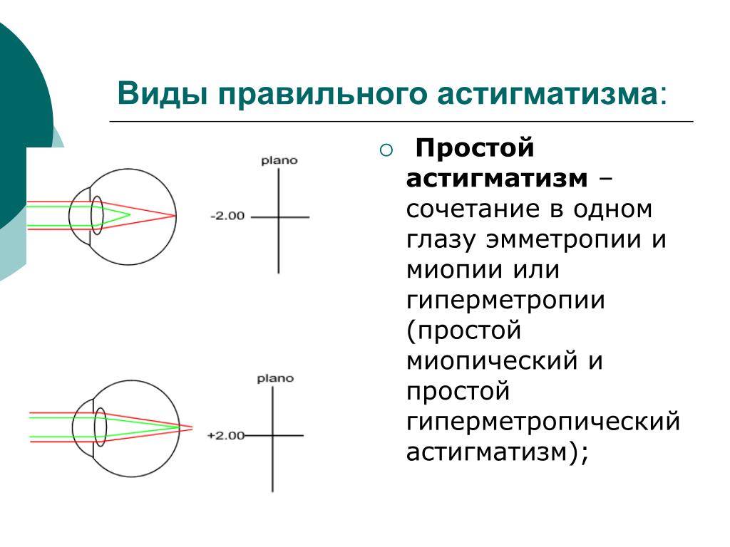 Упражнения для глаз при астигматизме — будет ли эффект? «ochkov.net»