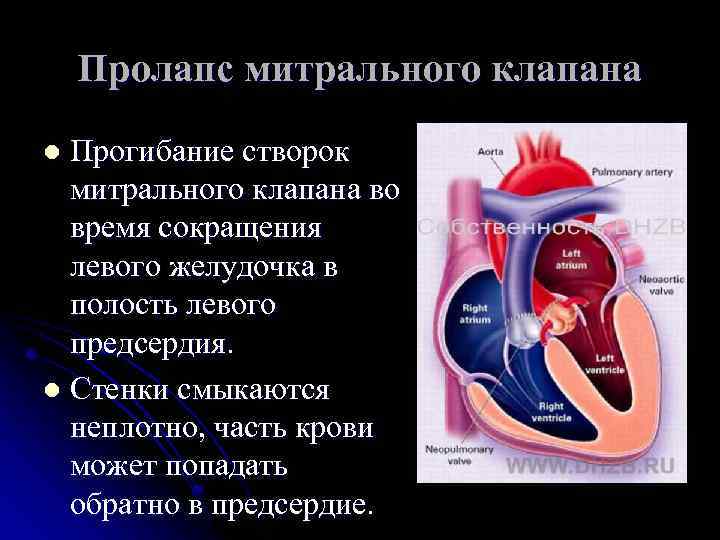 Пролапсы клапанов сердца