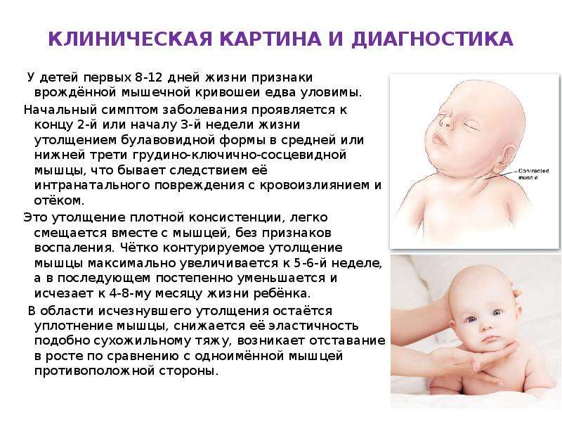 Кривошея - причины, признаки, методы лечения. кривошея у новорожденных