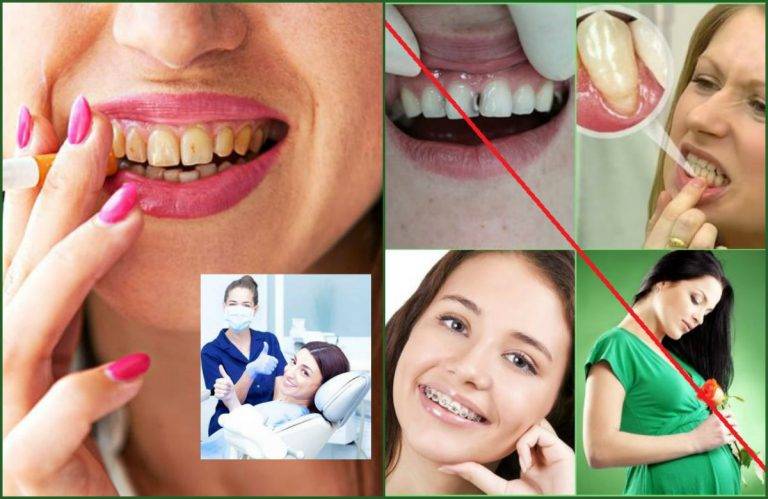 вред для здоровья отбеливания зубов
