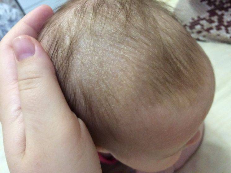 Поражения волосистой части головы у детей - доказательная медицина для всех