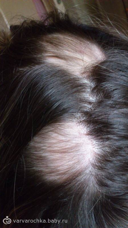 Выпадение волос после родов. как восстановить волосы после родов