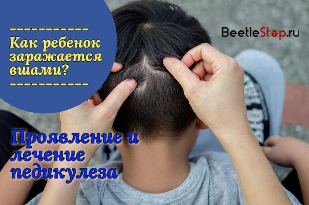 Что делать, если у ребенка вши и гниды: причины и лечение