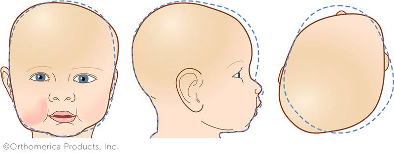 Деформация головы у новорожденного - что нужно знать родителям - beautyvertebro.com