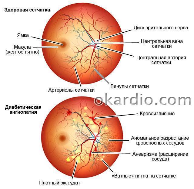 Ишемическая оптическая нейропатия обоих глаз у новорожденных — что это? - энциклопедия ochkov.net