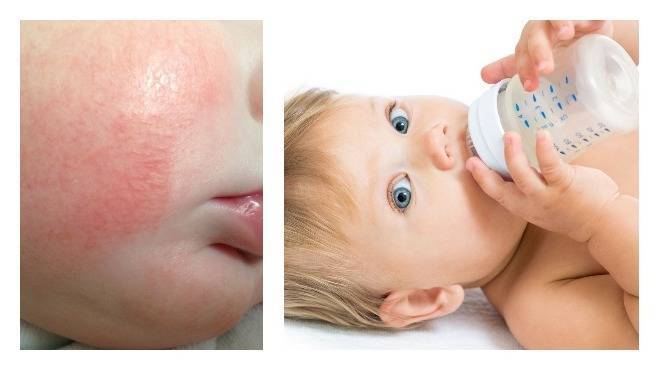 Если убрать аллерген через сколько пройдет сыпь у ребенка