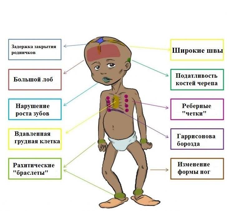 Рахит у детей - симптомы болезни, профилактика и лечение рахита у детей, причины заболевания и его диагностика на eurolab
