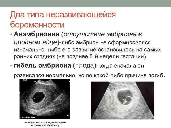 Замершая беременность: возникновение и диагностика