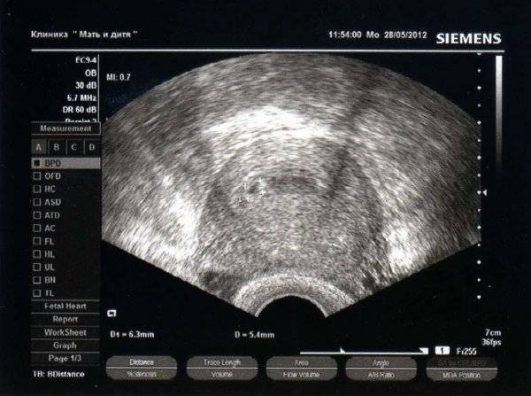 Амниоцентез при беременности: сроки и показания к процедуре | «юнона»