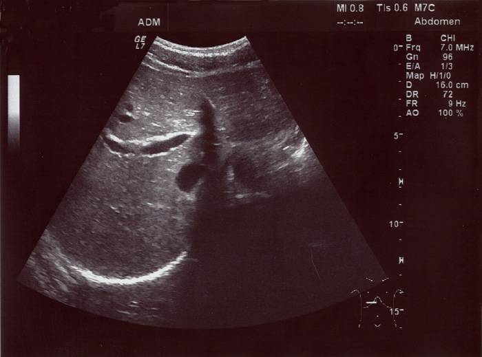 Замершая беременность на ранних сроках | медицинский центр «президент-мед»