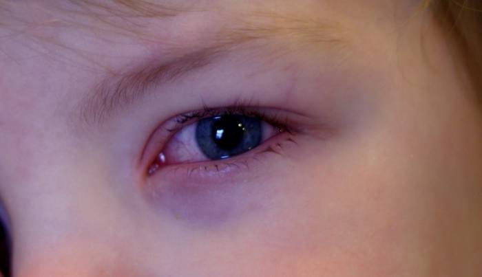 Покраснение глаз у детей: причины и лечение