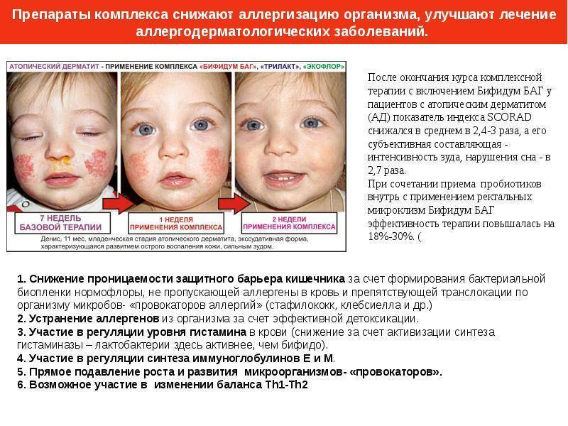 Аллергия у детей - как проявляется, чем лечат