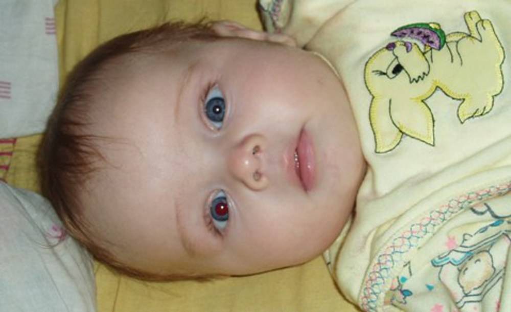 Разные по размеру зрачки у ребенка - причины анизокории | все о болезнях глаз