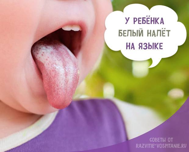 Жжение языка: причины, лечение  - стоматология блеск новосибирск
