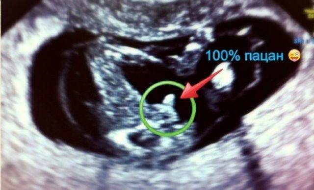 Узи ребенка на 11 неделе беременности: видно ли пол?
