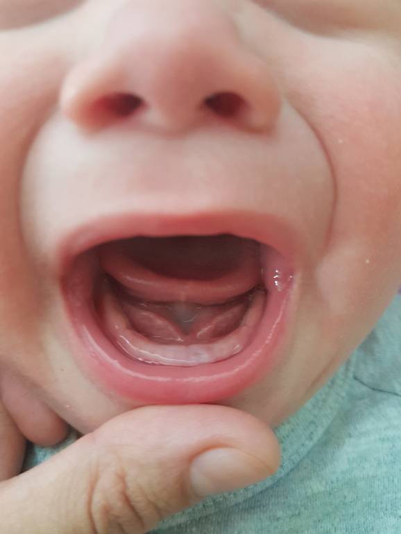 Может ли быть диарея при прорезывании молочных зубов у детей? как от неё избавиться?