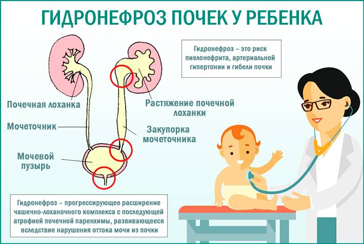 Расширенные лоханки почек у новорожденных. Гидронефроз почки у ребенка до года. Врожденный гидронефроз патогенез. Гидронефроз 4 степени у ребенка. Причины гидронефроза у детей.