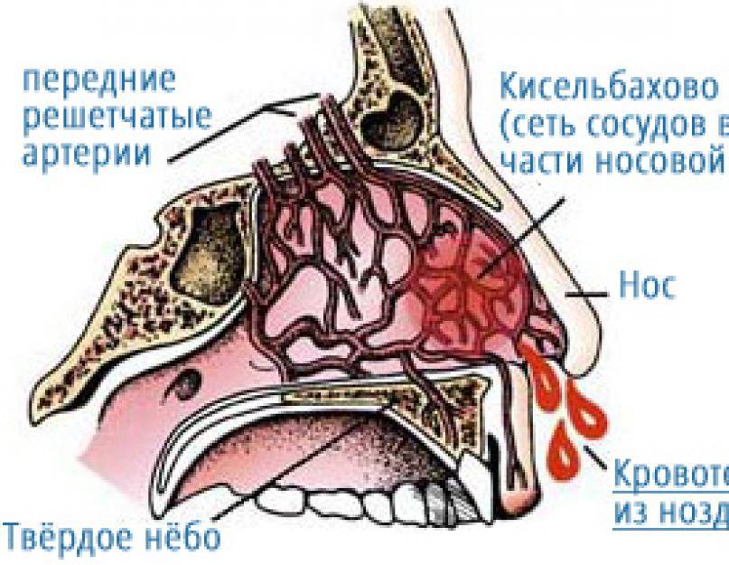 Как остановить кровь из носа?