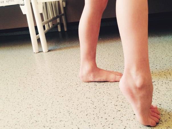 Ребенок постоянно ходит на носочках, как отучить? - доктор позвонков