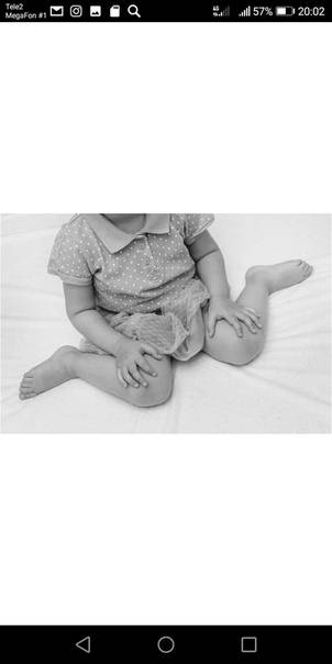 Признаки и лечение дисплазии тазобедренных суставов у детей