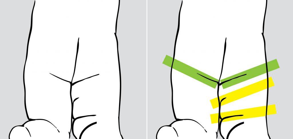 10 способов убрать носогубные складки