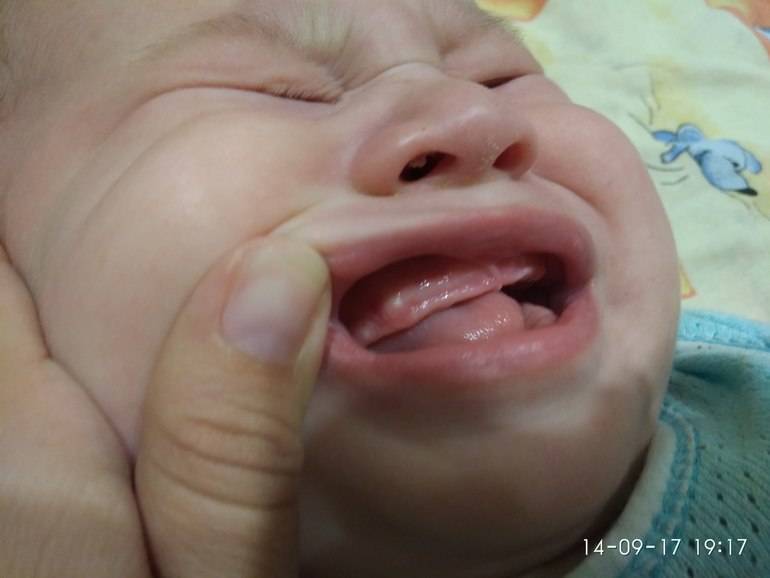 Кокой первый зуб лезет первым у грудничка: верхние или нижние вылазят у младенцев