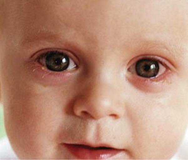 Каковы причины конъюнктивита у младенца и как его лечить? - энциклопедия ochkov.net
