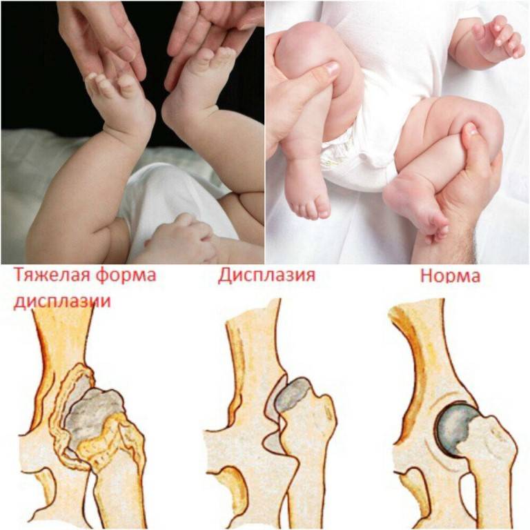 Признаки и лечение дисплазии тазобедренных суставов у детей
