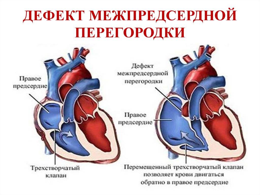 Стеноз легочной артерии | эндоваскулярное лечение врожденных пороков сердца в институте амосова