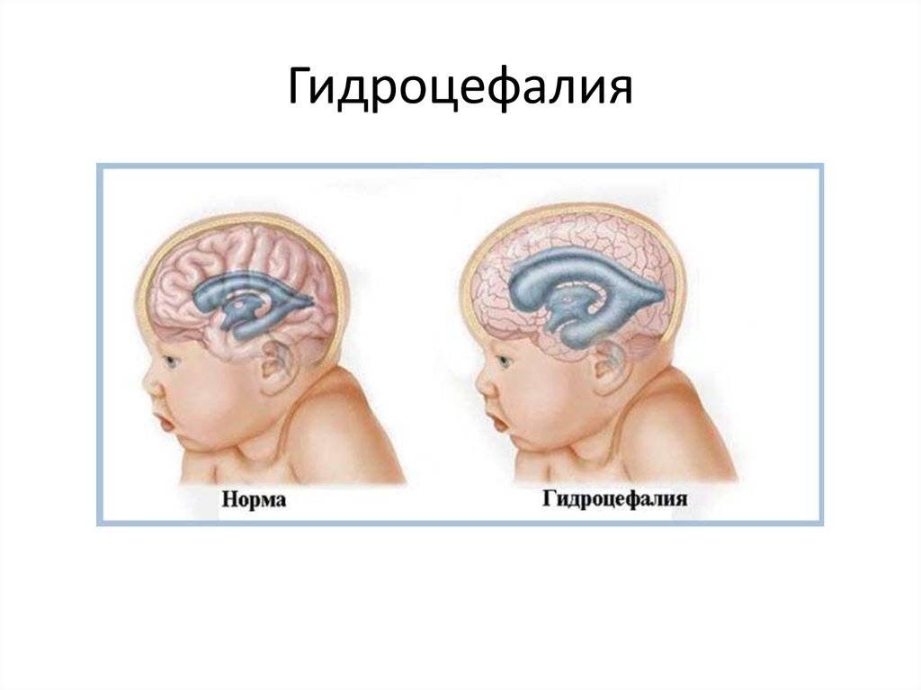 Гидроцефалия головного мозга у новорожденных и взрослых: симптомы, причины, диагностика, лечение
