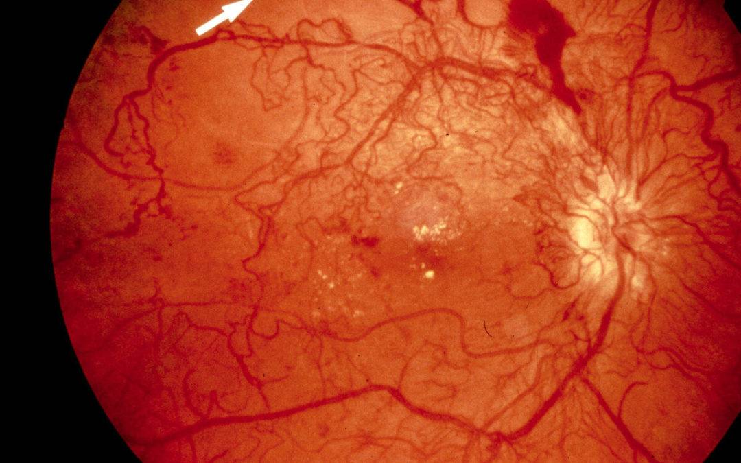 Из-за чего возникает фоновая ретинопатия и как она лечится?
