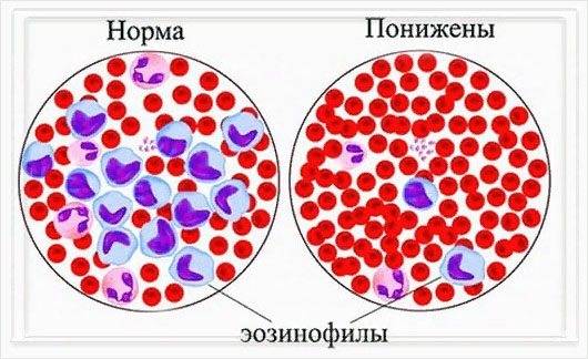 Почему повышены эозинофилы в крови у ребенка, причины их повышения - городская больница
