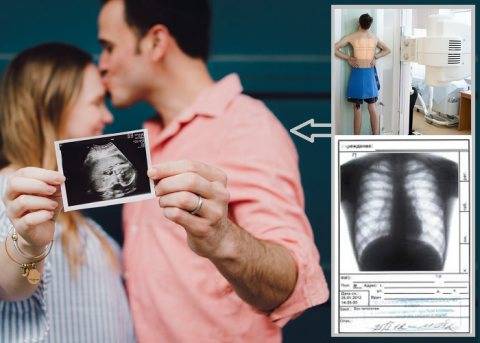 Опасность рентгена при беременности - рентген легких, зуба, носа на раннем и позднем сроке беременности :: polismed.com