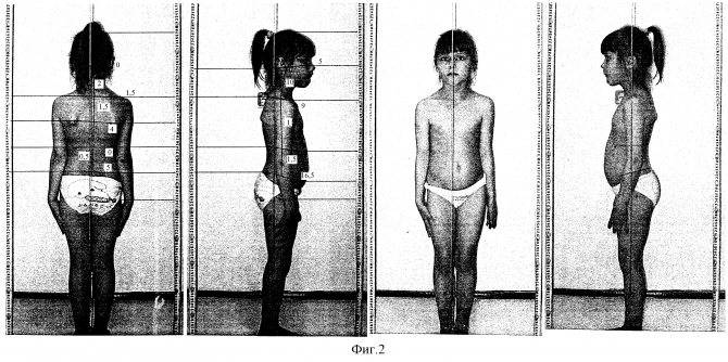 Изолированное телархе, преждевременное половое развитие - вопрос детскому эндокринологу - 03 онлайн