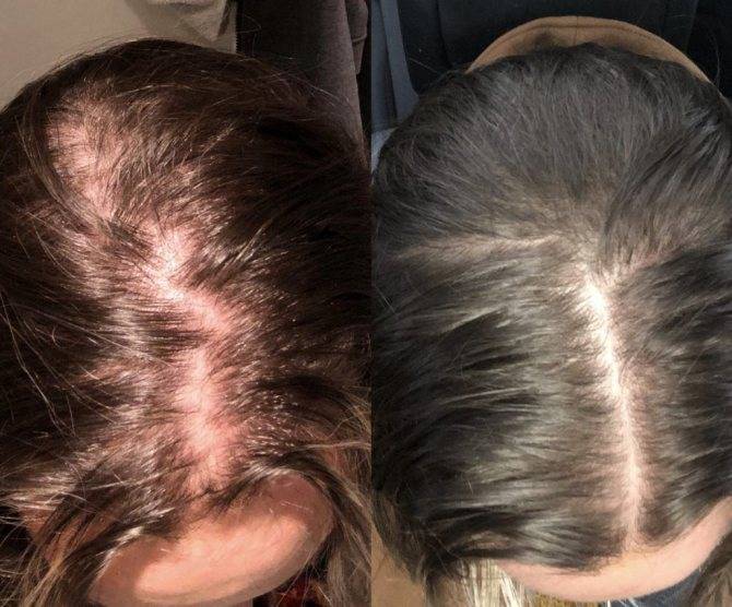 Выпадение волос из-за стресса. как остановить выпадение волос?