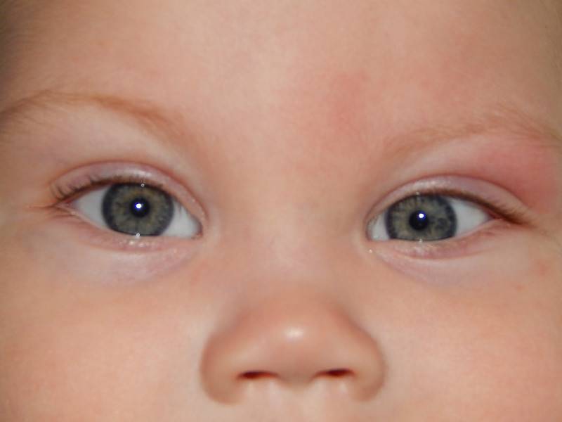 Почему у новорожденного один глаз открывается больше другого