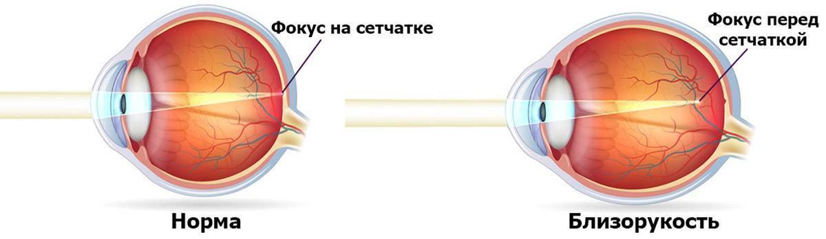 Изображение перед сетчаткой это