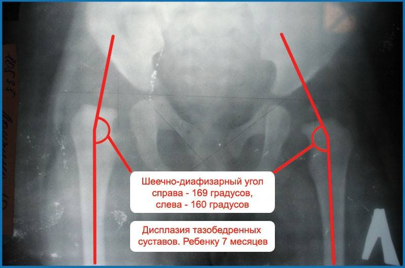 Виды заболеваний тазобедренного сустава | артромедцентр